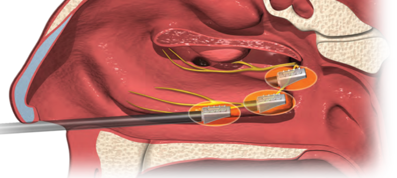 a-new-procedure-for-chronic-rhinitis-towson-maryland-ent-surgery